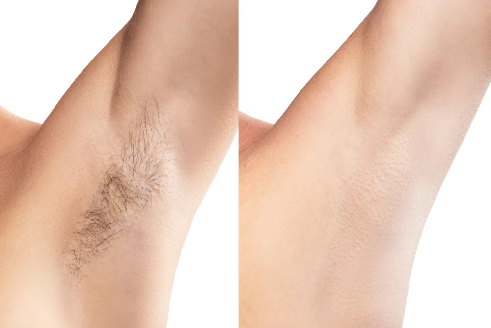 Before and after of underarm laser hair removal treatment.