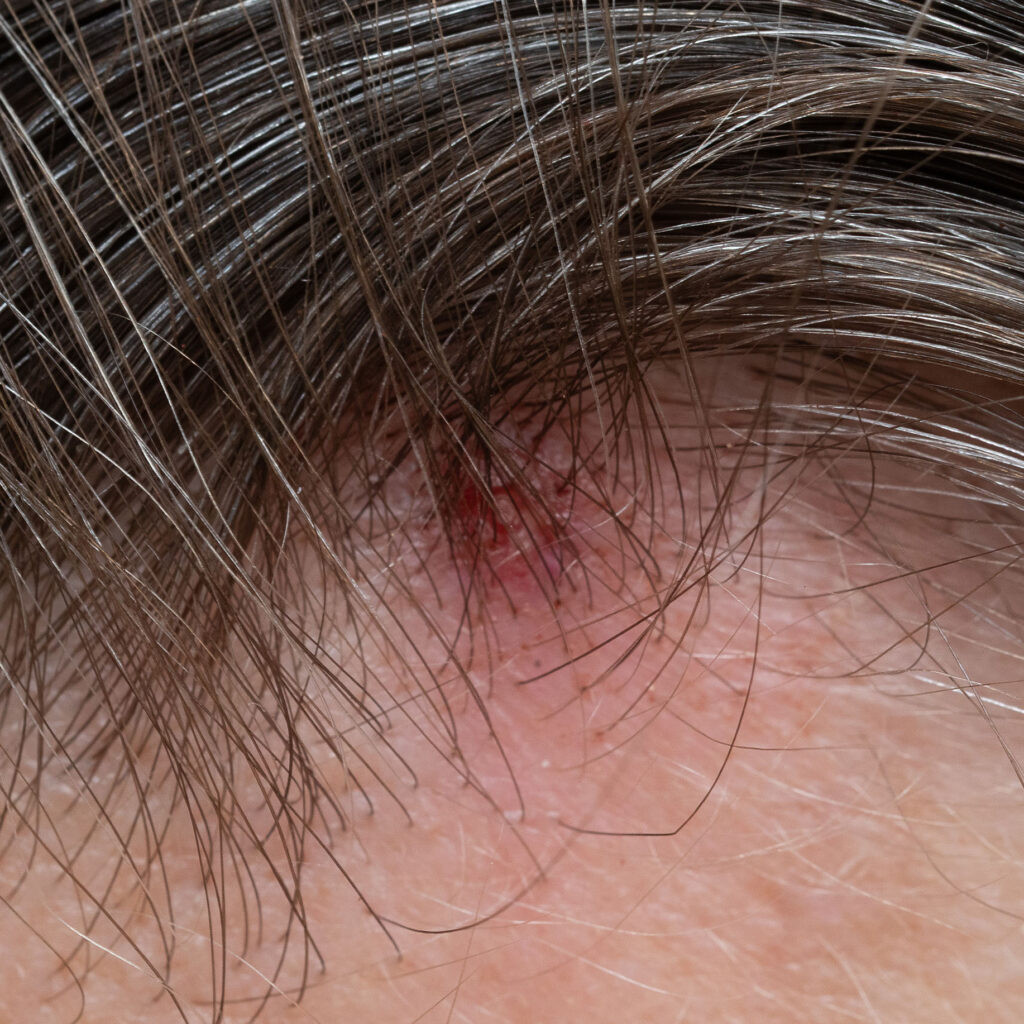 close-up of scalp with redness and mild irritation under strands of brown hair