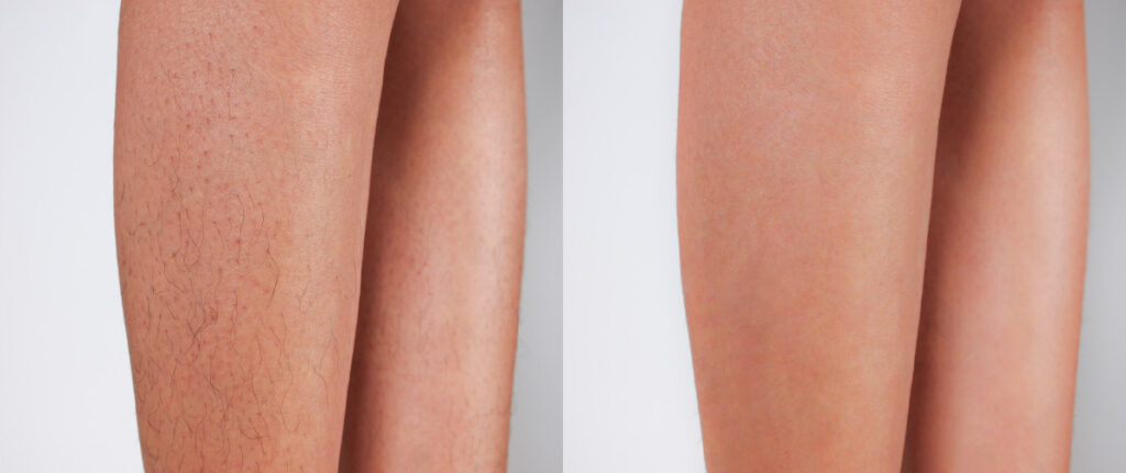 two close-up views of lower legs shown side by side, one with visible hair and one with minimal visible hair